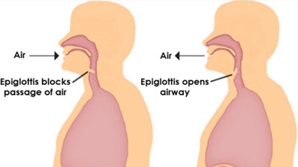 hiccups