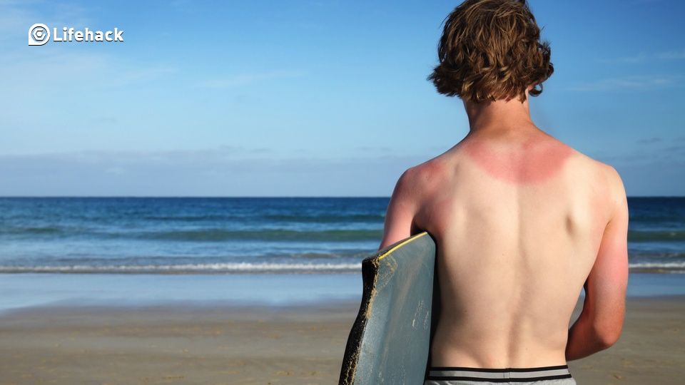 So You’ve Got a Sunburn…Here’s What To Do