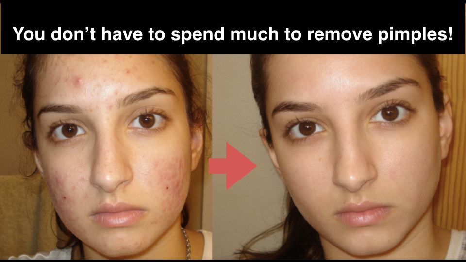 10 Natural Home Remedies to Get Rid of Acne Fast (No More Acne Scars!)