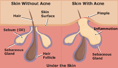 Fast remedies to ways home clear acne ACNE HOME