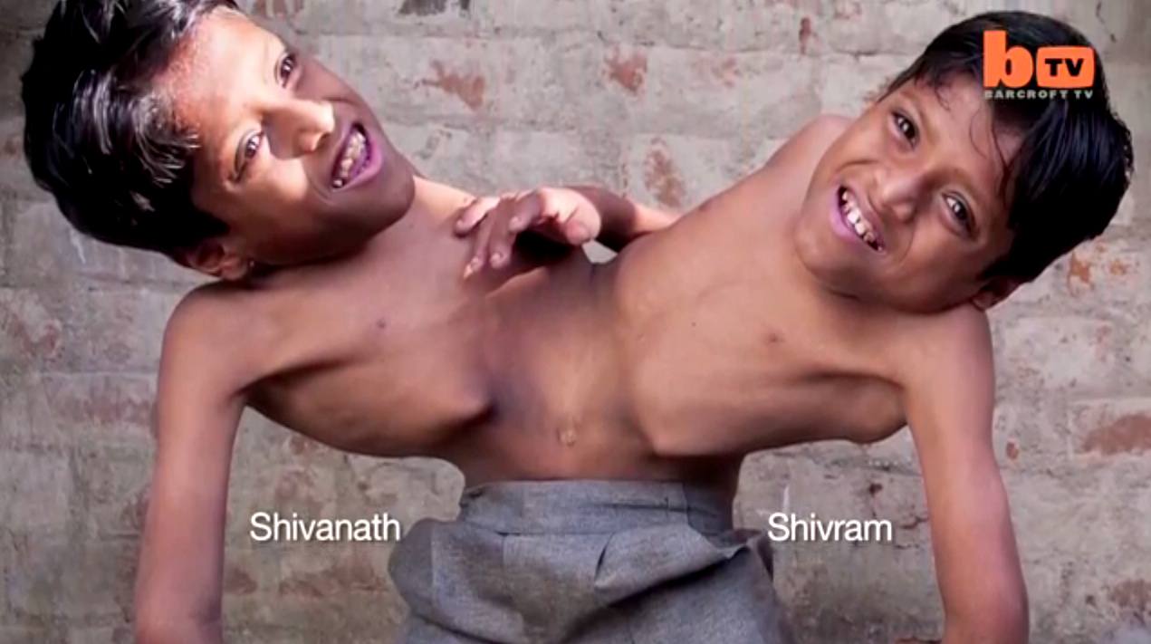The Story Of These Conjoined Twins Will Teach You What Living In Harmony Means