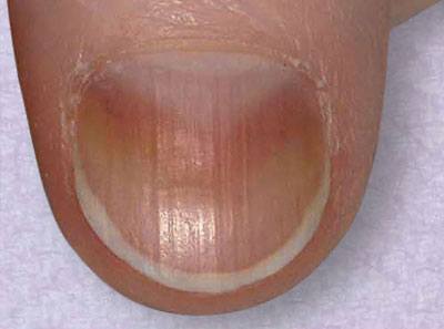 nail-ridges