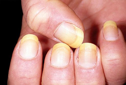 yellow-nails