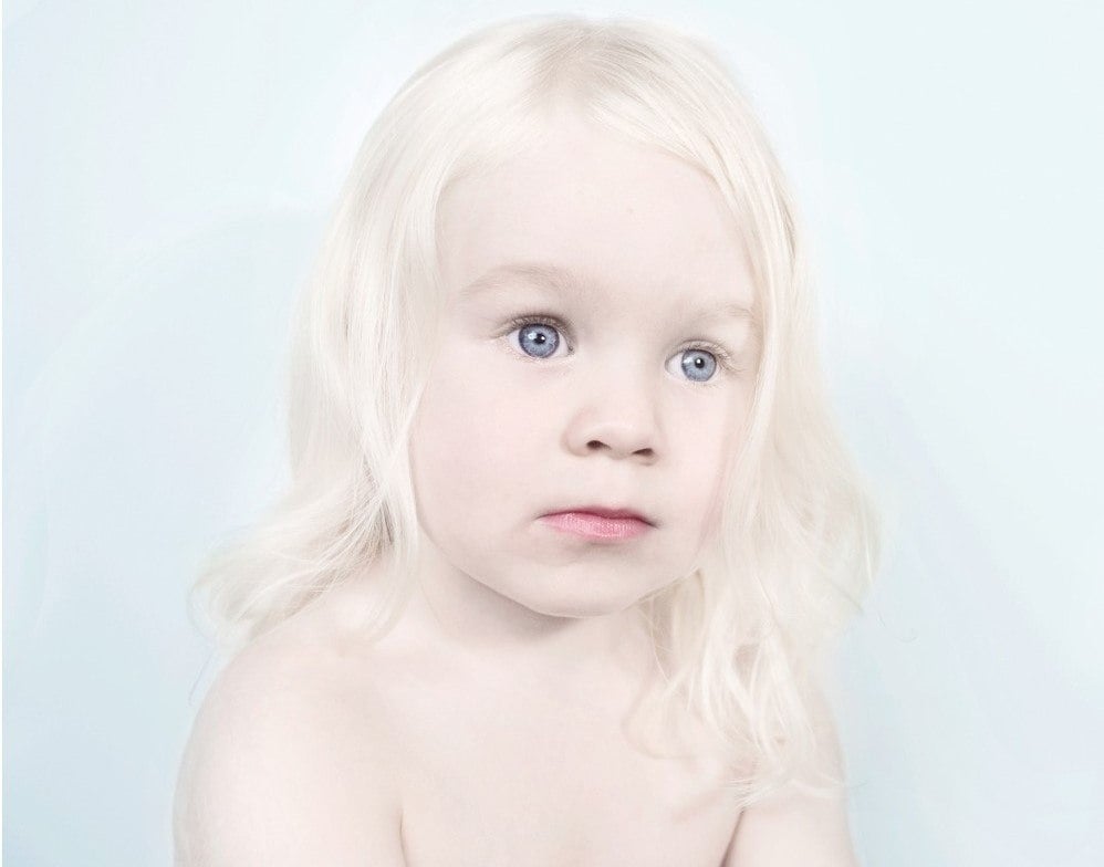 9 Things Only People With Albinism Would Understand