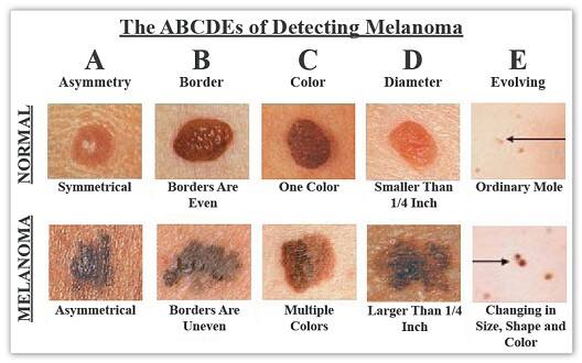 Identifying melanoma