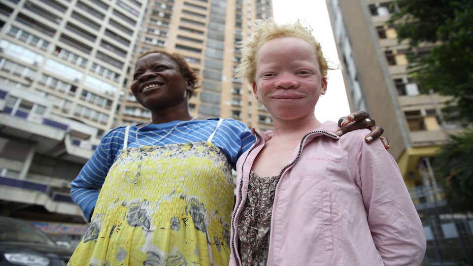 9 Things Only People With Albinism Can Understand