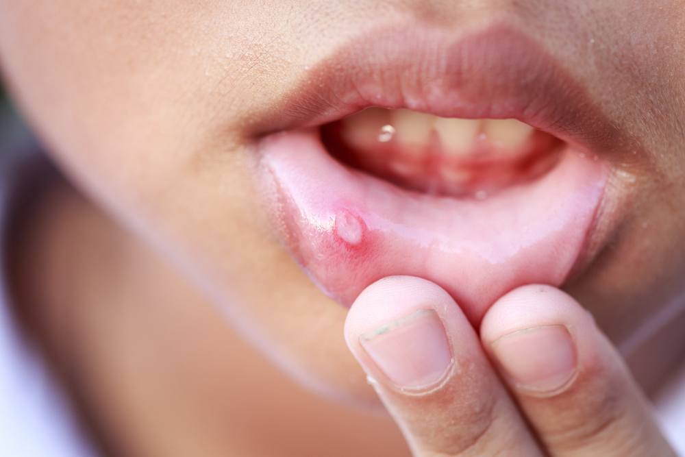 How To Get Rid Of Canker Sores Naturally And Fast