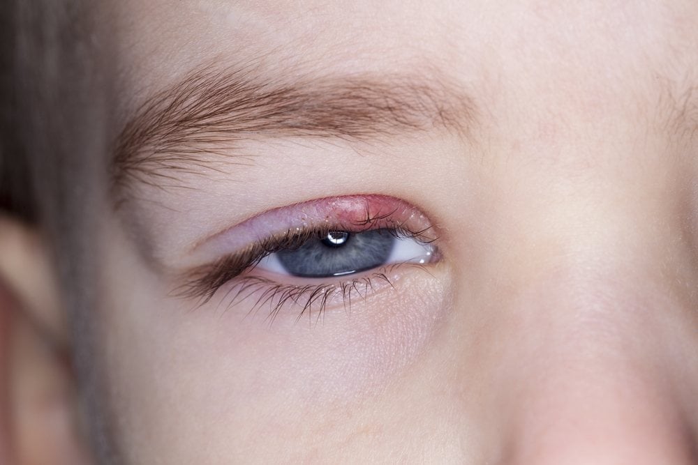 12 Quick And Safe Ways To Get Rid Of A Stye