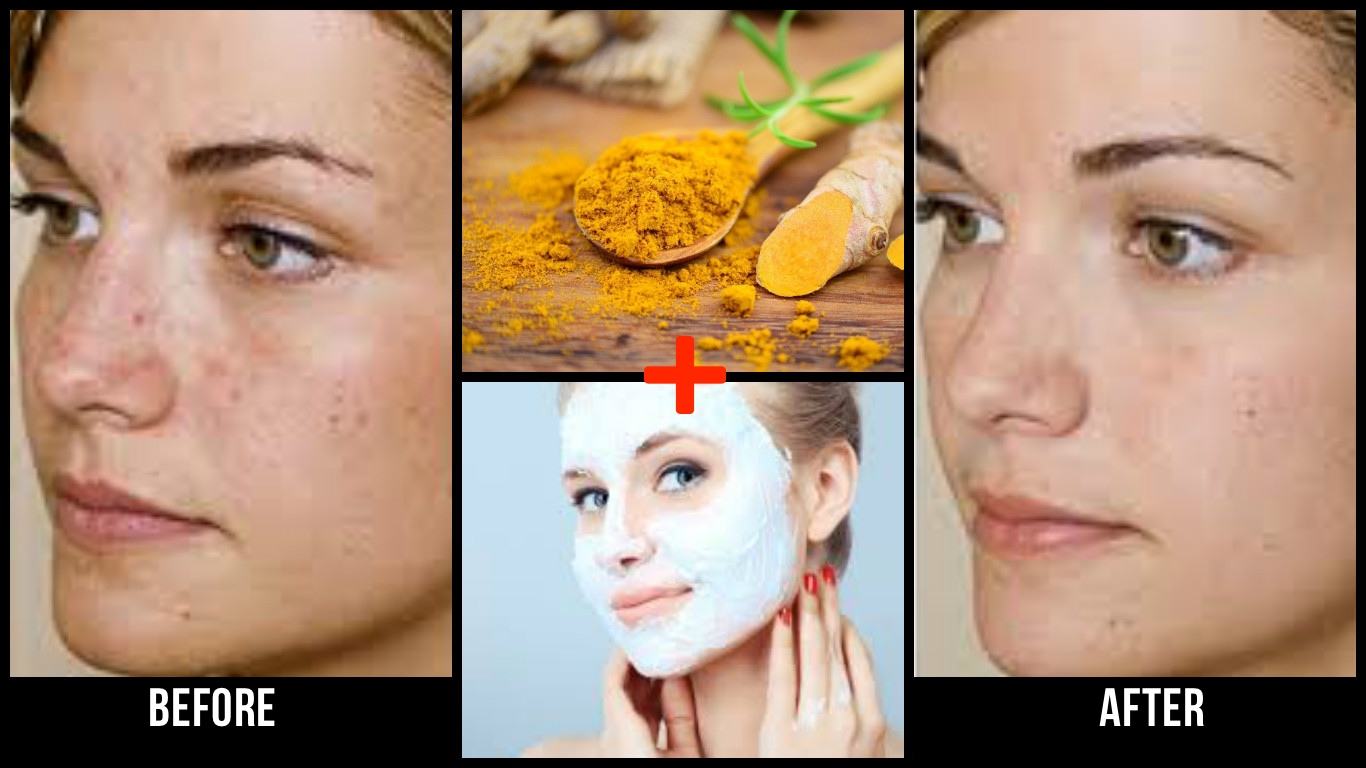Easy DIY Turmeric Face Mask For Acne-Free Radiant Skin