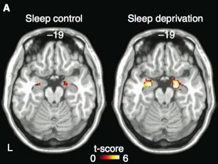 Sleep Deprived Brain