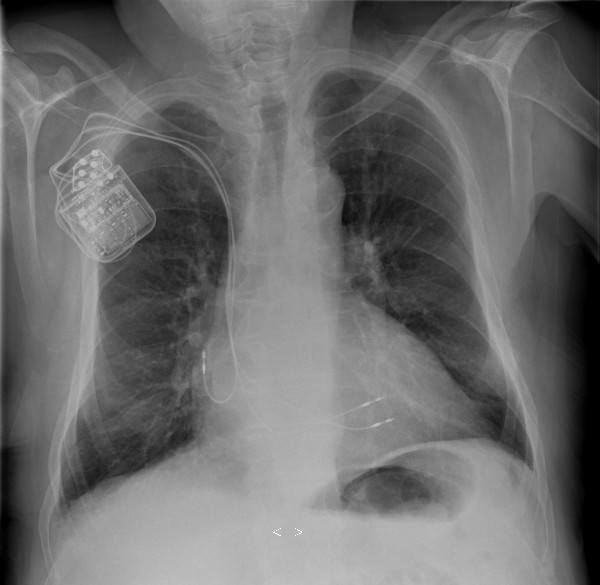 x-ray_of_patient_with_ccm_device_pa_view