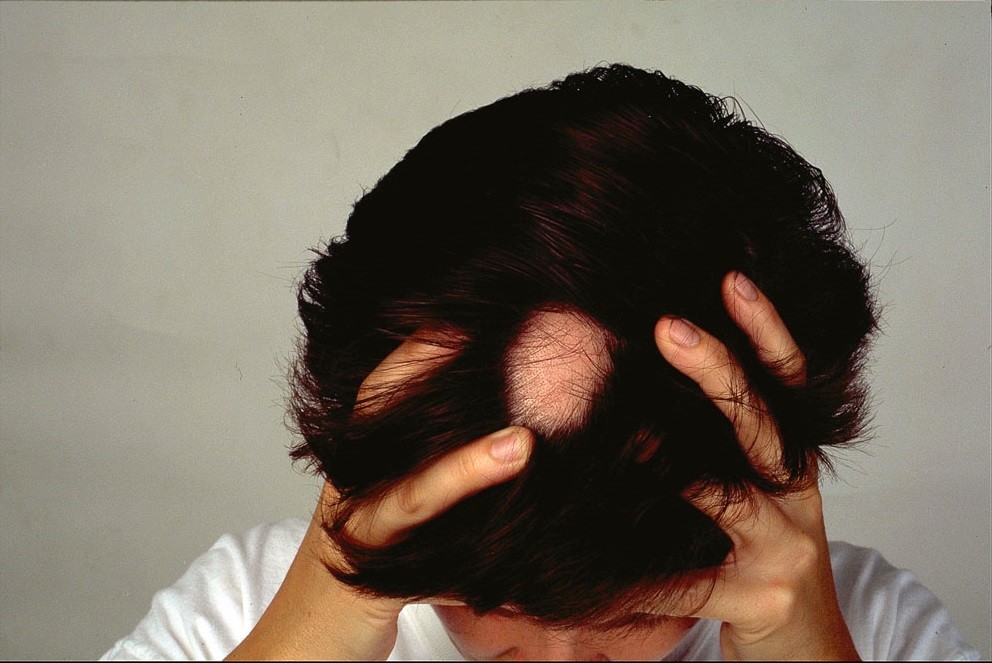 5 Effective Treatments for Alopecia