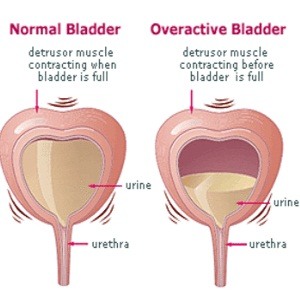 overactive-bladder