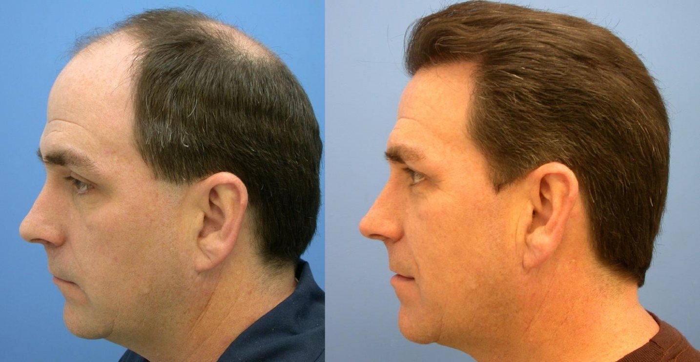 This is what you need to know about FUE Hair Transplant