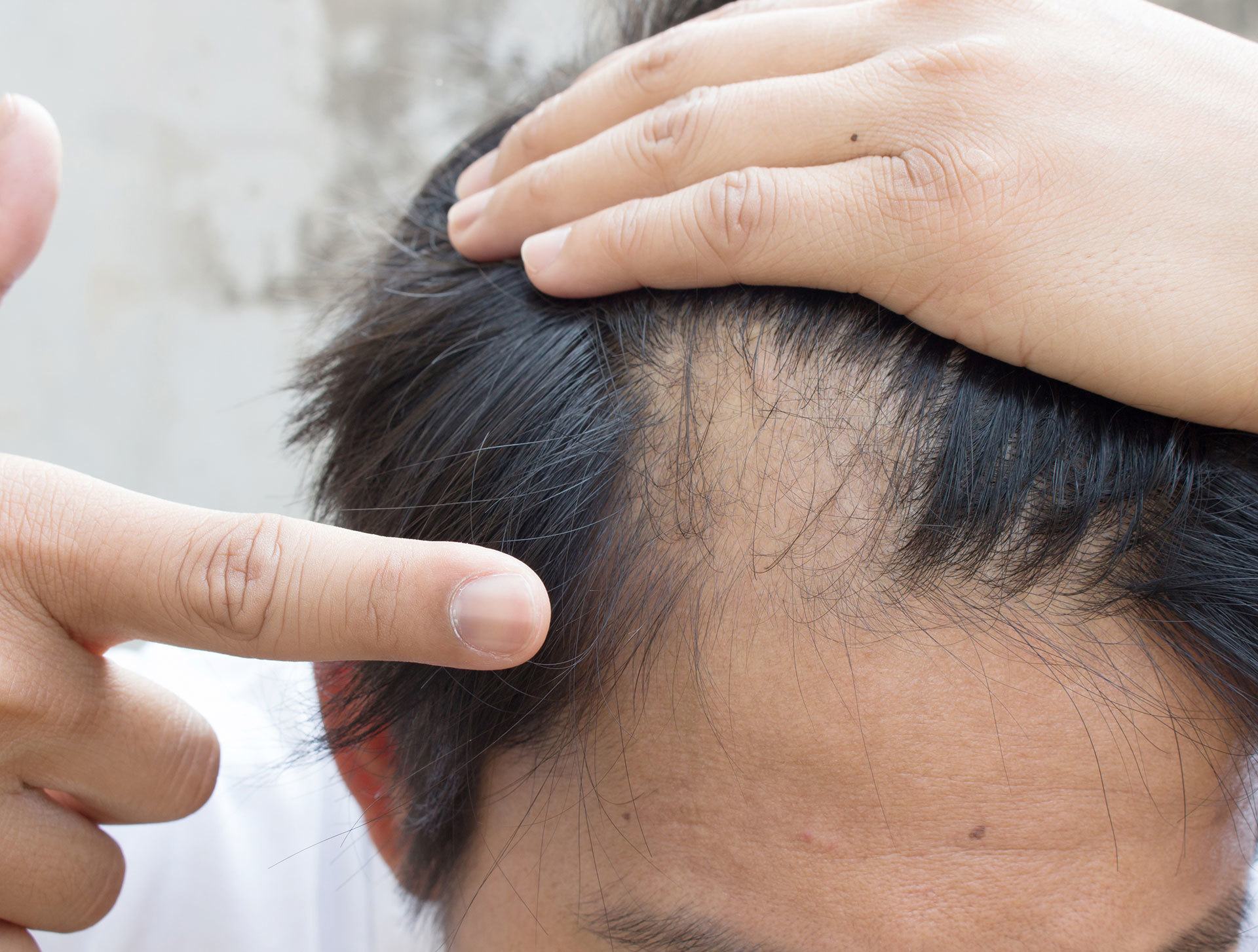 The 5 Suprising Remedies That Stop Hair Loss Naturally